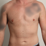 Gynecomastia Before & After Patient #4213