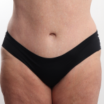 Tummy Tuck Before & After Patient #4304