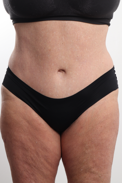 Tummy Tuck Before & After Patient #4304