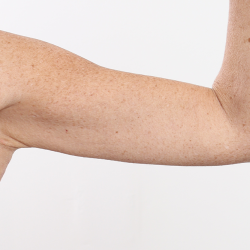 Arm Lift Before & After Patient #4305