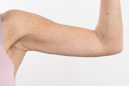 Arm Lift Before & After Patient #4305