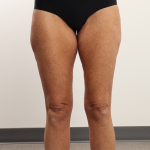 Thigh Lift Before & After Patient #4348