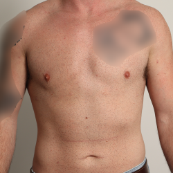 Gynecomastia Before & After Patient #4213