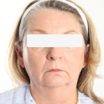 Morpheus8 Before & After Patient #4227