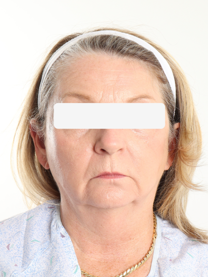 Morpheus8 Before & After Patient #4227