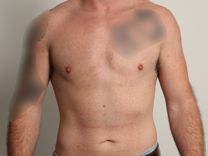 Gynecomastia Before & After Patient #4213