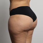 Brazilian Butt Lift Before & After Patient #4226