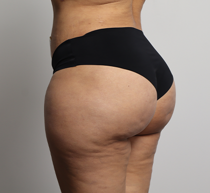 Brazilian Butt Lift Before & After Patient #4226