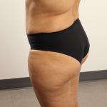 Brazilian Butt Lift Before & After Patient #4226