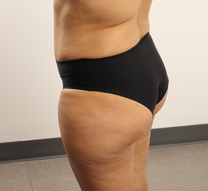 Brazilian Butt Lift Before & After Patient #4226