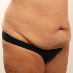Tummy Tuck Before & After Patient #4304