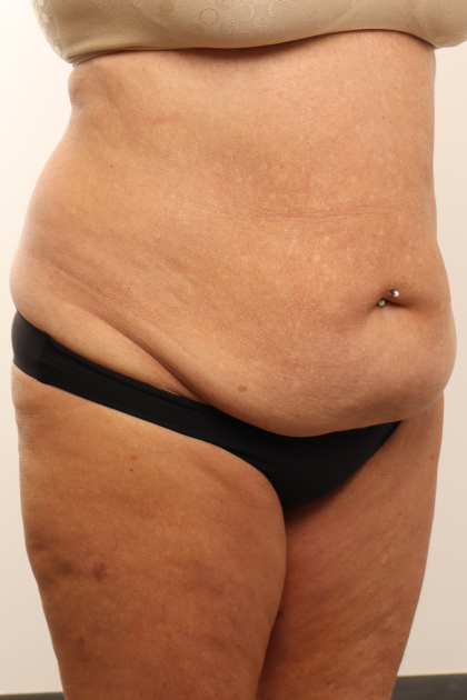 Tummy Tuck Before & After Patient #4304