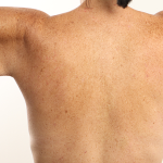 Arm Lift Before & After Patient #4305