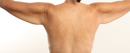 Arm Lift Before & After Patient #4305