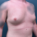 Gynecomastia Before & After Patient #4213