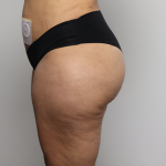 Brazilian Butt Lift Before & After Patient #4226