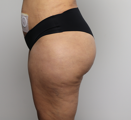 Brazilian Butt Lift Before & After Patient #4226