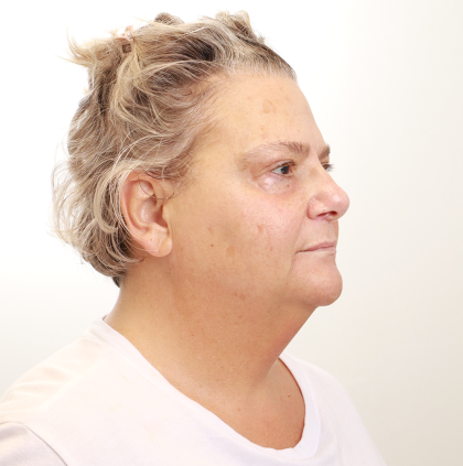 MOXI Laser Before & After Patient #4254