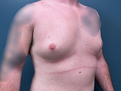 Gynecomastia Before & After Patient #4213