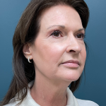 Facelift Before & After Patient #4293