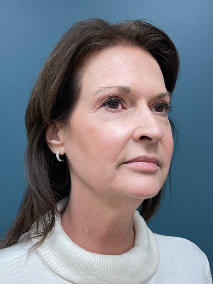 Facelift Before & After Patient #4293