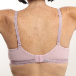 Arm Lift Before & After Patient #4305