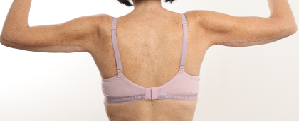 Arm Lift Before & After Patient #4305