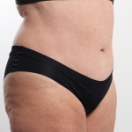 Tummy Tuck Before & After Patient #4304