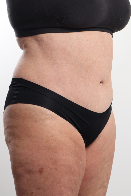 Tummy Tuck Before & After Patient #4304