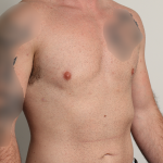 Gynecomastia Before & After Patient #4213