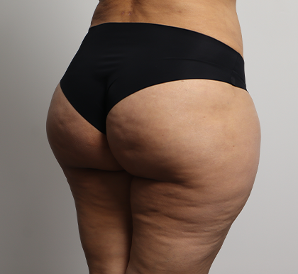 Brazilian Butt Lift Before & After Patient #4226