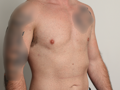 Gynecomastia Before & After Patient #4213
