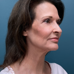 Facelift Before & After Patient #4293