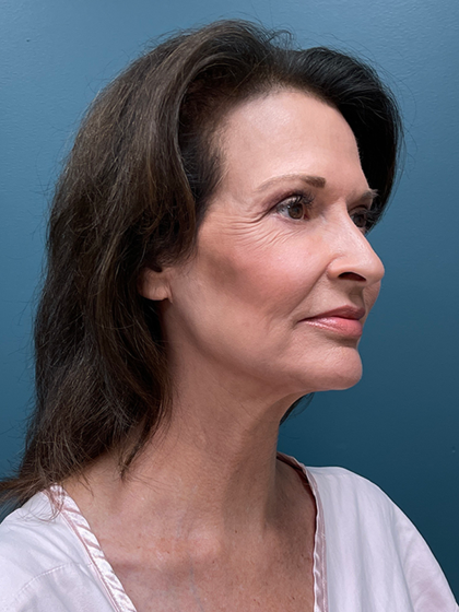 Facelift Before & After Patient #4293