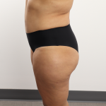 Brazilian Butt Lift Before & After Patient #4226