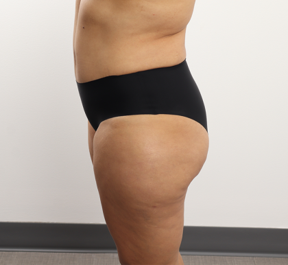 Brazilian Butt Lift Before & After Patient #4226
