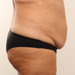 Tummy Tuck Before & After Patient #4304