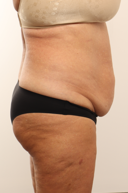Tummy Tuck Before & After Patient #4304