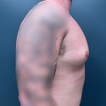 Gynecomastia Before & After Patient #4213