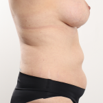 Tummy Tuck Before & After Patient #4224