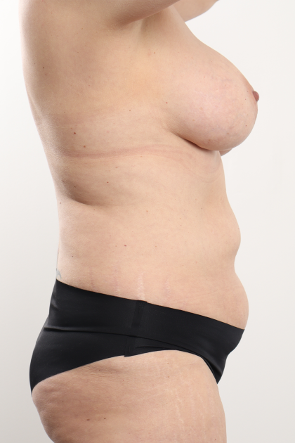 Tummy Tuck Before & After Patient #4224