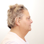 MOXI Laser Before & After Patient #4254