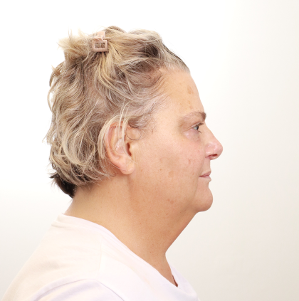 MOXI Laser Before & After Patient #4254
