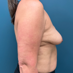 Breast Revision Before & After Patient #4257