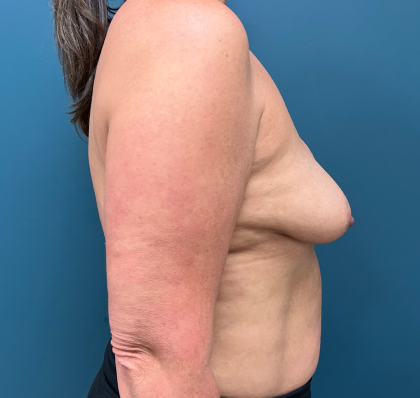 Breast Revision Before & After Patient #4257