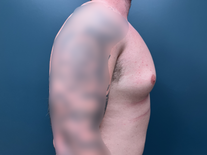 Gynecomastia Before & After Patient #4213
