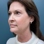 Facelift Before & After Patient #4293