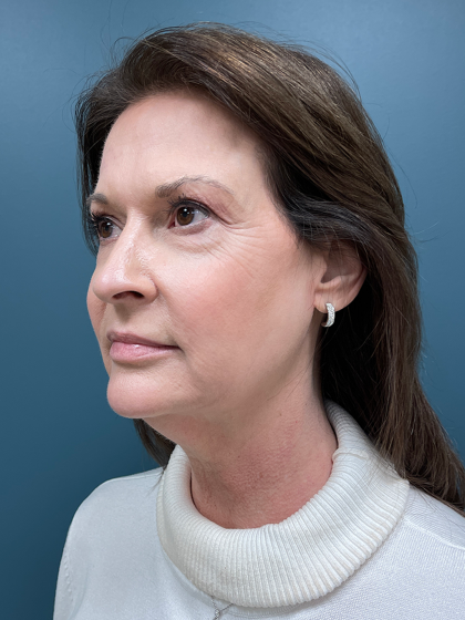 Facelift Before & After Patient #4293