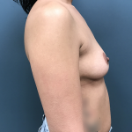 Breast Augmentation Before & After Patient #4300