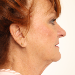 Rhinoplasty Before & After Patient #4302